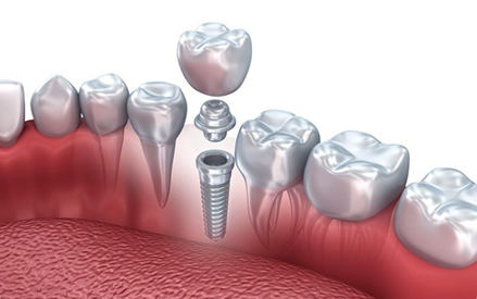 Triển vọng phát triển của vật liệu titan chi tiết y tế.